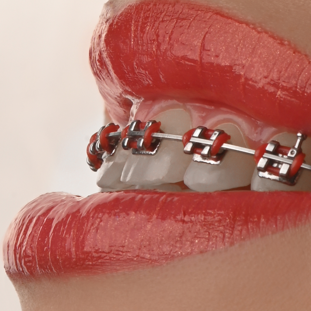 براکت فلزی American Orthodontics - 9