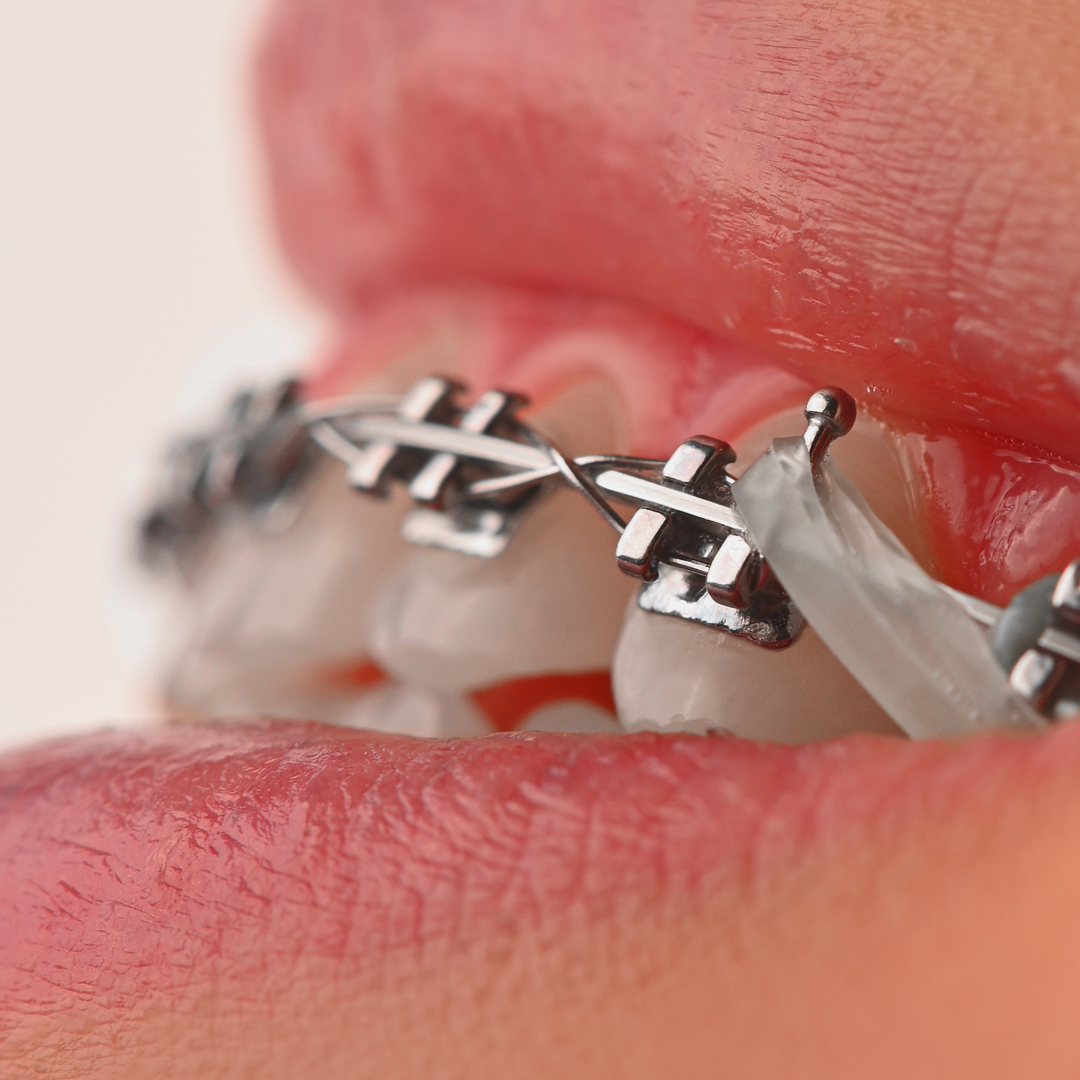 براکت فلزی American Orthodontics - 14