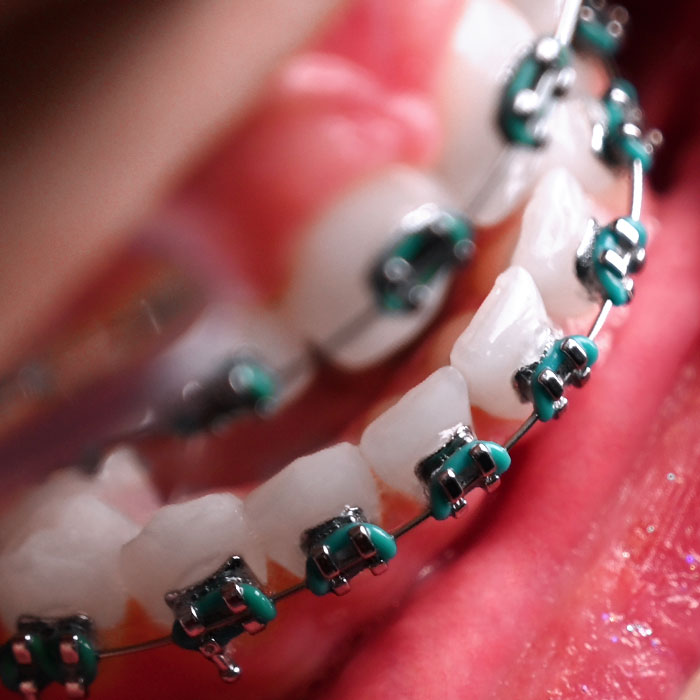 براکت فلزی American Orthodontics - 12