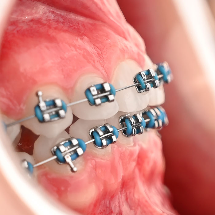 براکت فلزی American Orthodontics - 10