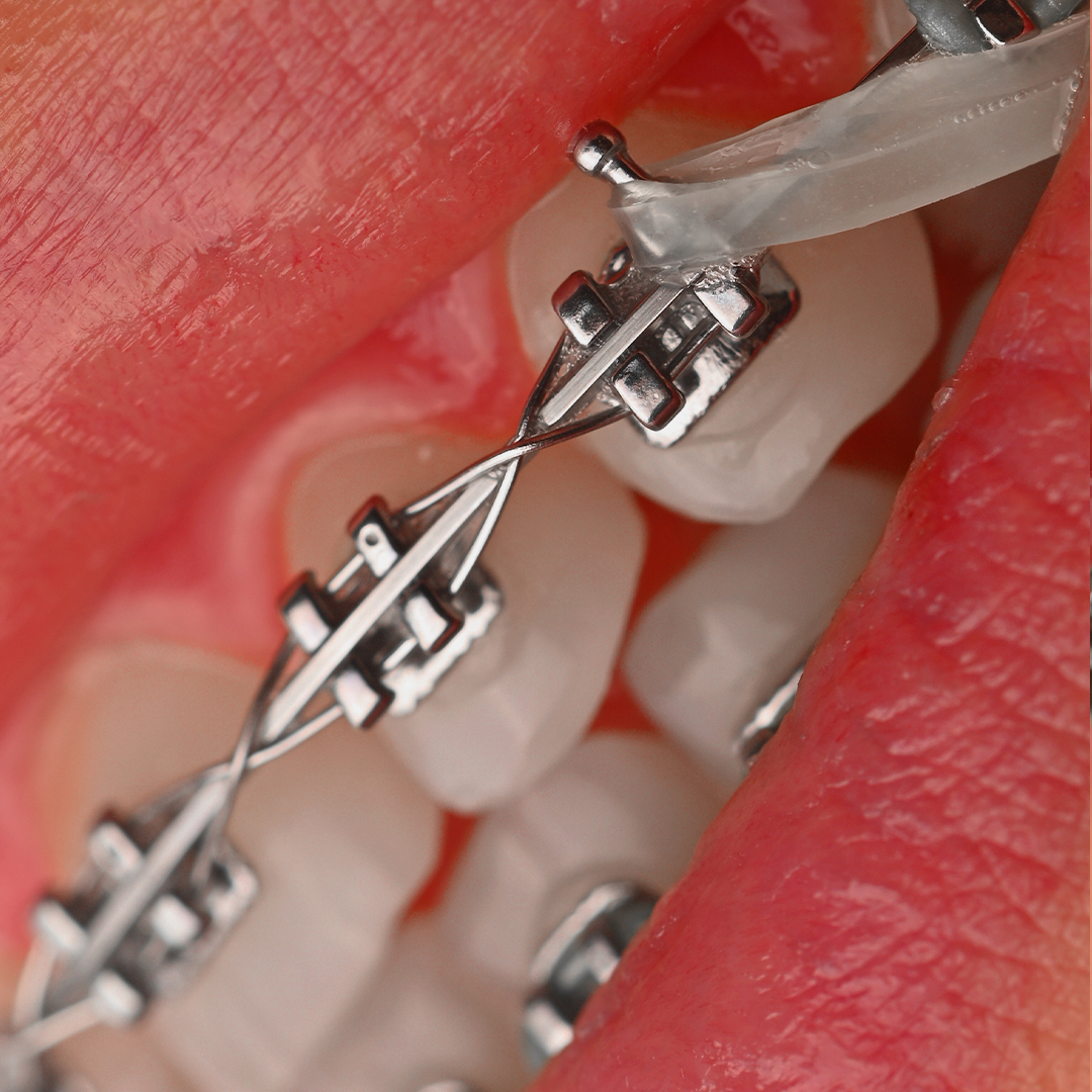 براکت فلزی American Orthodontics - 24