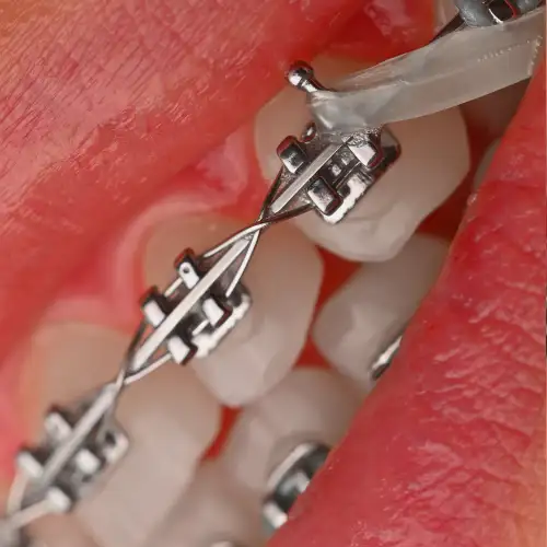 براکت فلزی American Orthodontics - 21