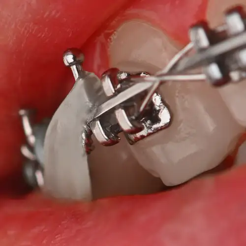 براکت فلزی American Orthodontics - 19