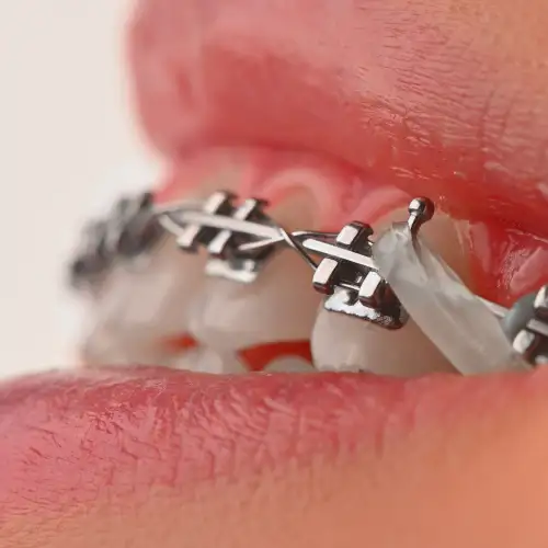 براکت فلزی American Orthodontics - 11