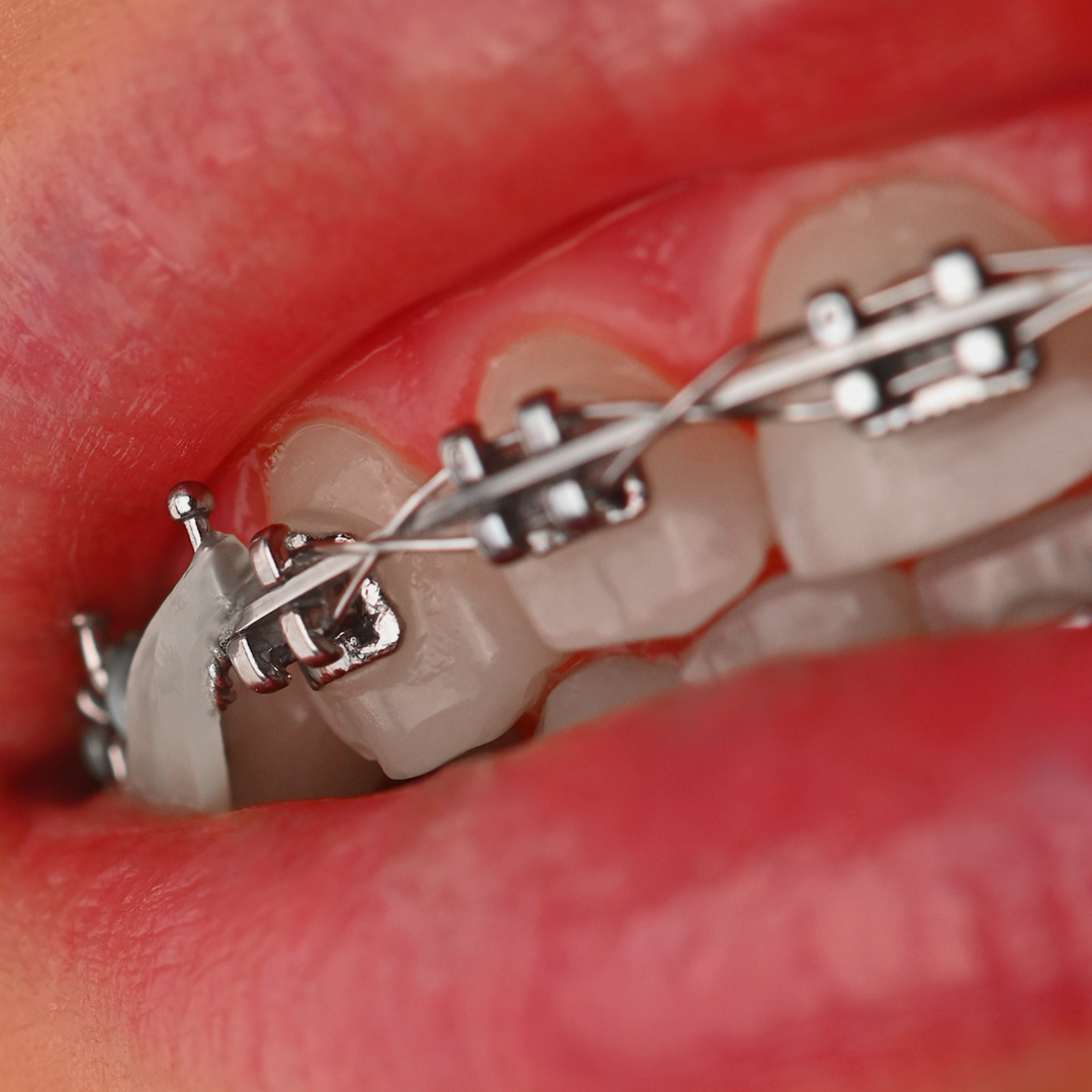 براکت فلزی American Orthodontics - 20