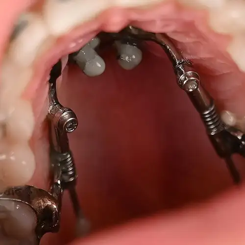 کیت دیستال جت American Orthodontics - 3