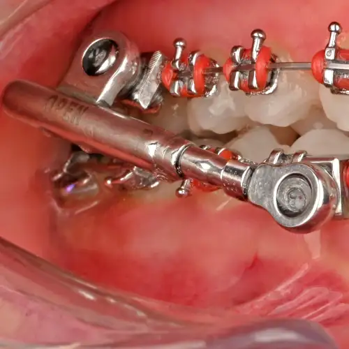 پاور اسکوپ 2 American Orthodontics - 9