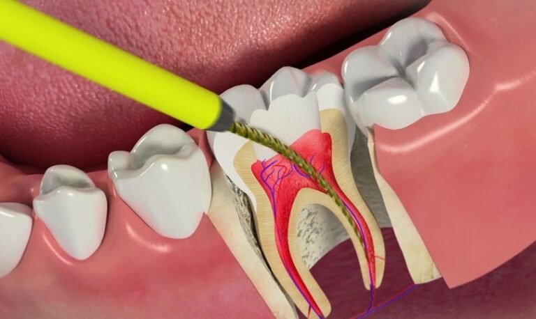 انواع تجهیزات عصب کشی دندان
