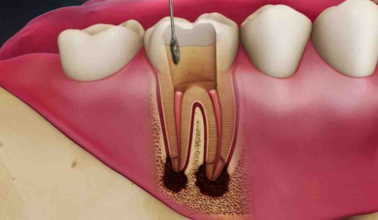 برخی دیگر از انواع تجهیزات عصب کشی دندان