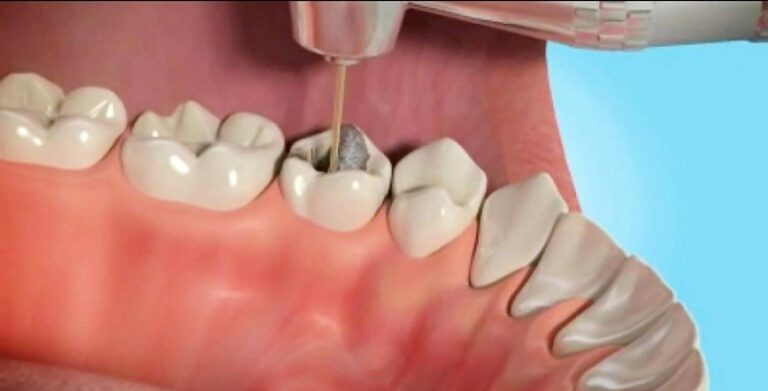 چگونه براکت ارتودنسی بر عصب کشی دندان تأثیر می‌گذارد؟